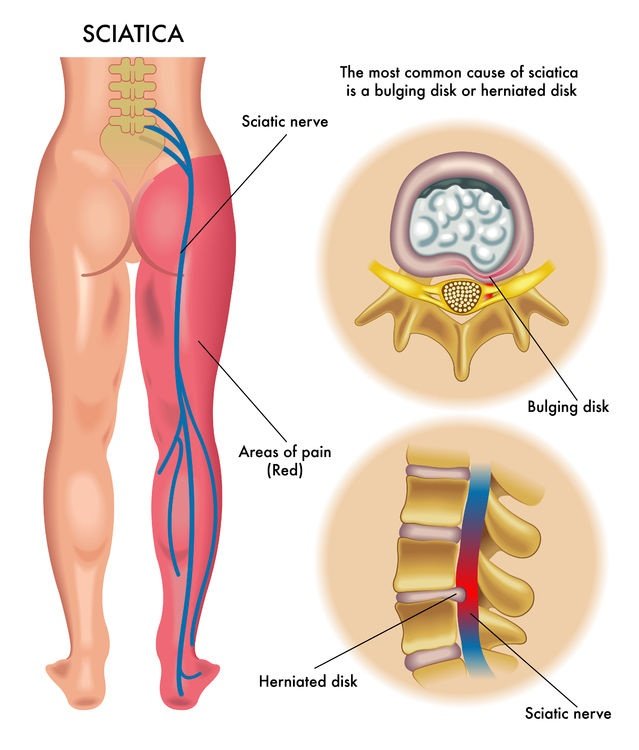 Diagram showing sciatic nerve pathway from lower back through buttocks and down leg, highlighting common pain points and compression areas